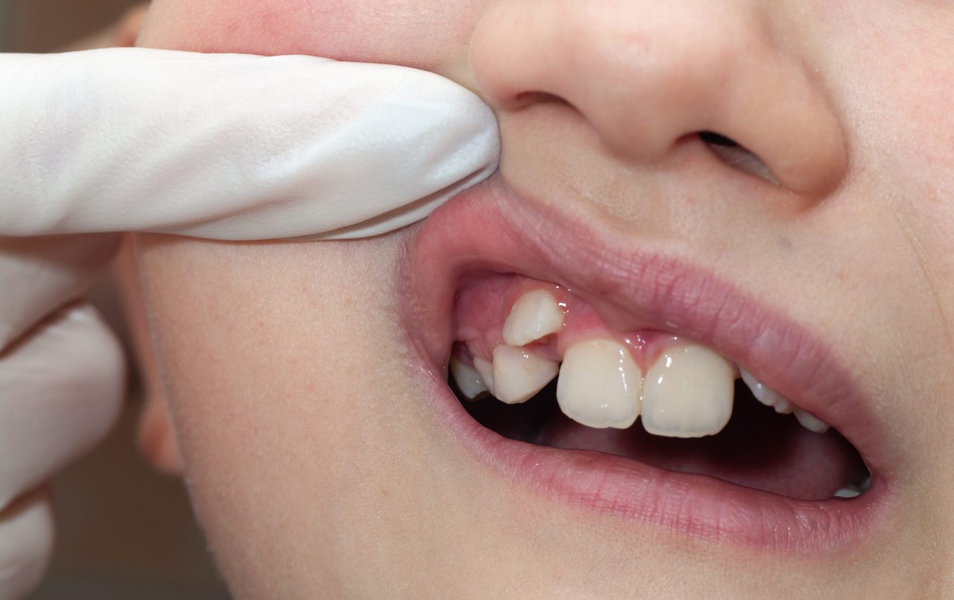 Orthodontiste technique de dégagement des dents incluses